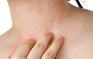 aloe vera para la dermatitis en adultos